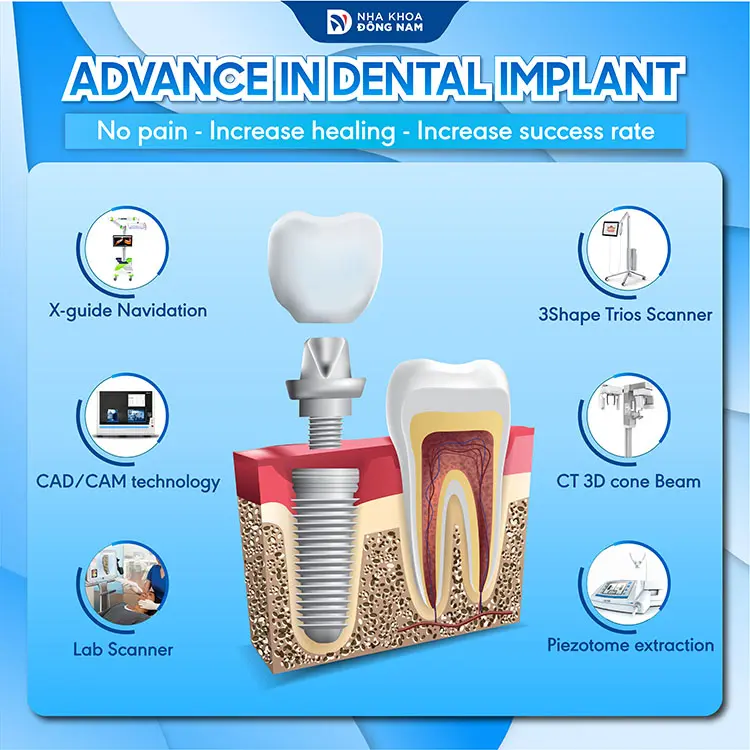 advance in dental implant