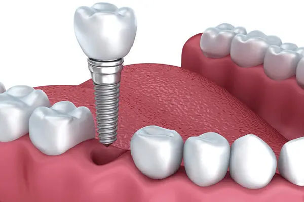 dental implant real